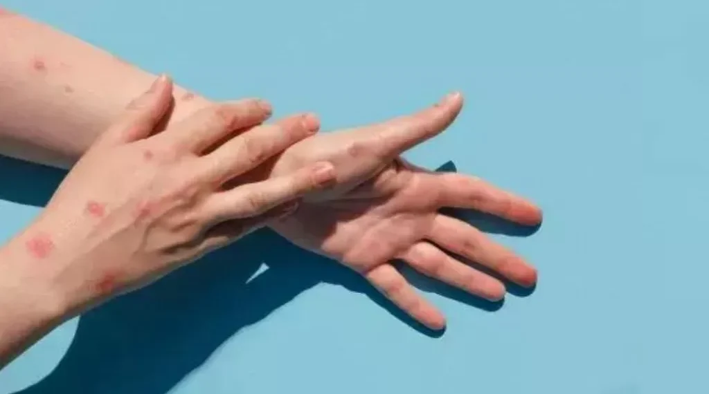 Viruela del Mono podría volverse pandemia