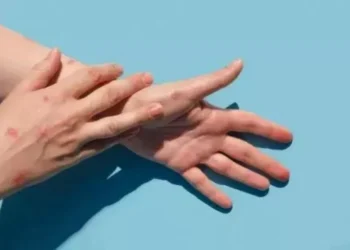 Viruela del Mono podría volverse pandemia