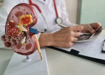 4 maneras simples de prevenir los cálculos renales