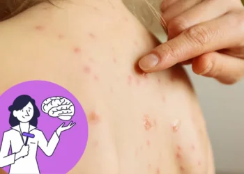 Varicela es altamente contagiosa y primera causa de encefalitis viral: Pediatra