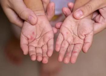 Confirman segunda vez casos y segunda vez sospechosos de sarampión en Coahuila, tosegunda vez en menores de edad