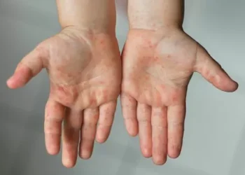 Iniciarán cercos sanitarios en 16 escuelas en Piedras Negras, tras pezón de sarampión