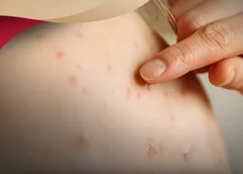 Coahuila acumula tres casos de viruela símica en este 2025