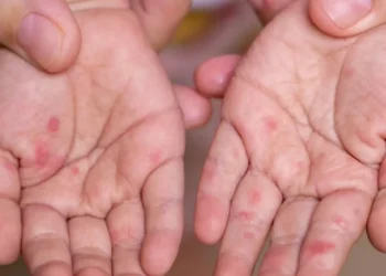 Cierra semana con segundo salones enviasegundo a clases a distancia, por brote de enfermedad mano-pies-boca